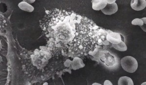 La relacion entre el cannabis y los canceres foto de celula cancerigena La relacion entre el cannabis y los canceres