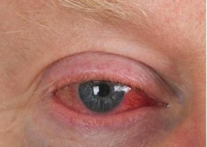 El cannabis y sus efectos en los ojos